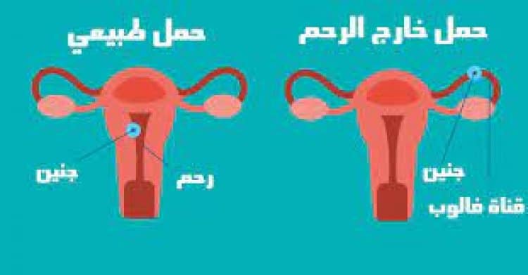 حمل خارج الرحم